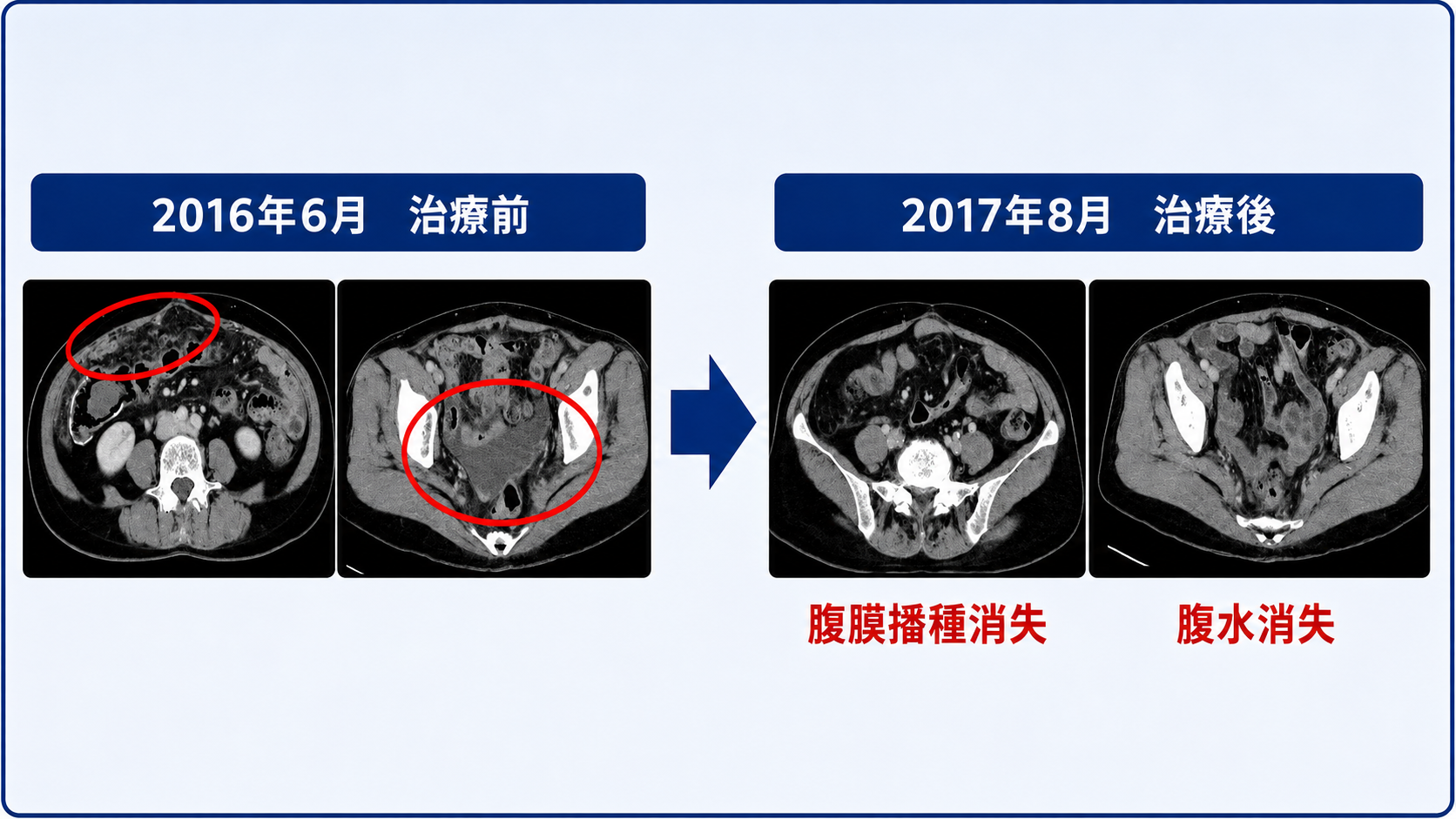 大腸がん腹膜播種の治療イメージ