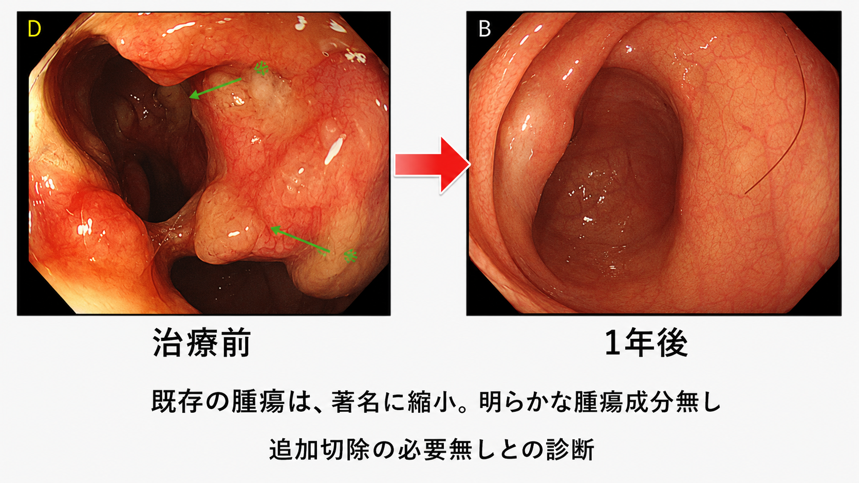 大腸 が ん ステージ 4