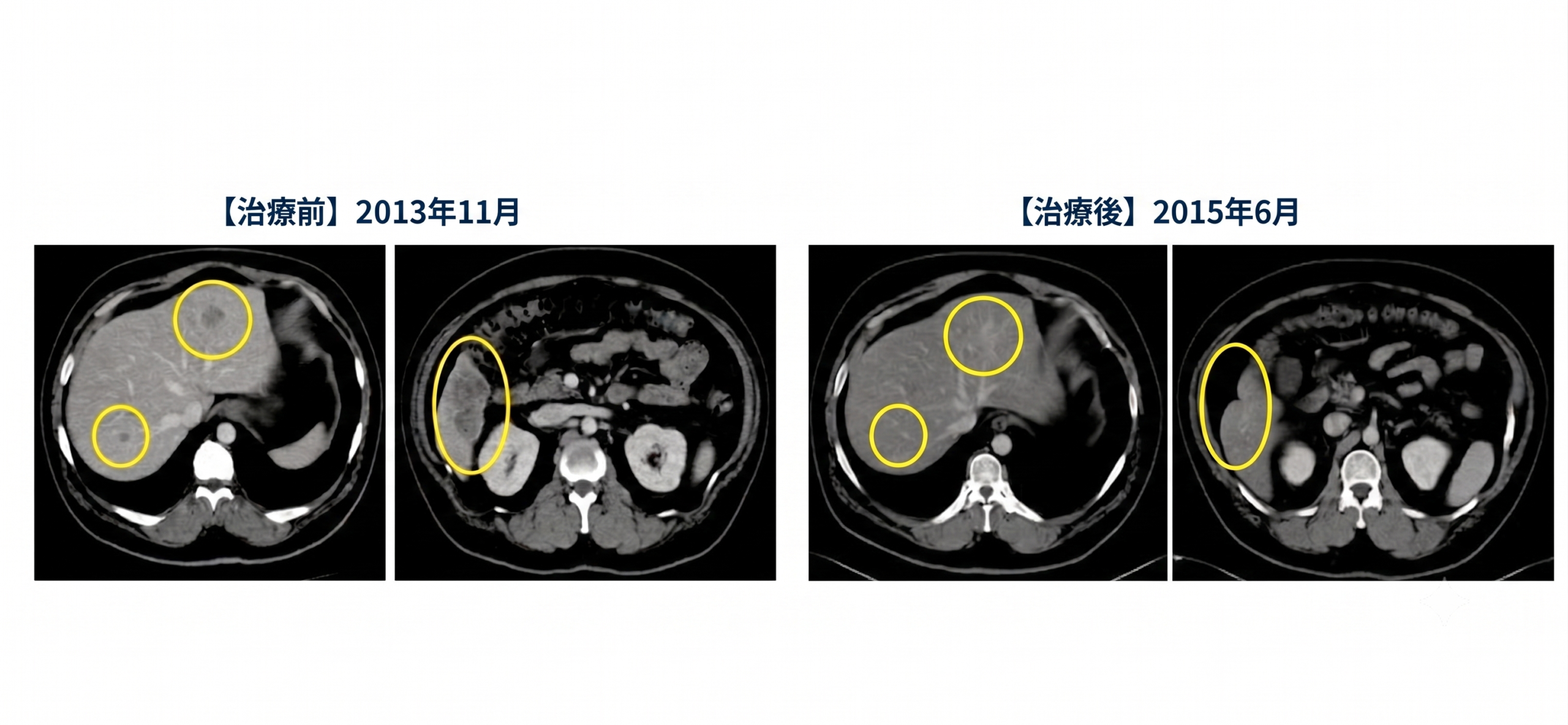 食道がん肝転移の治療前後CT比較。2013年11月に認めた肝臓の多発転移が、2015年6月には消失している。