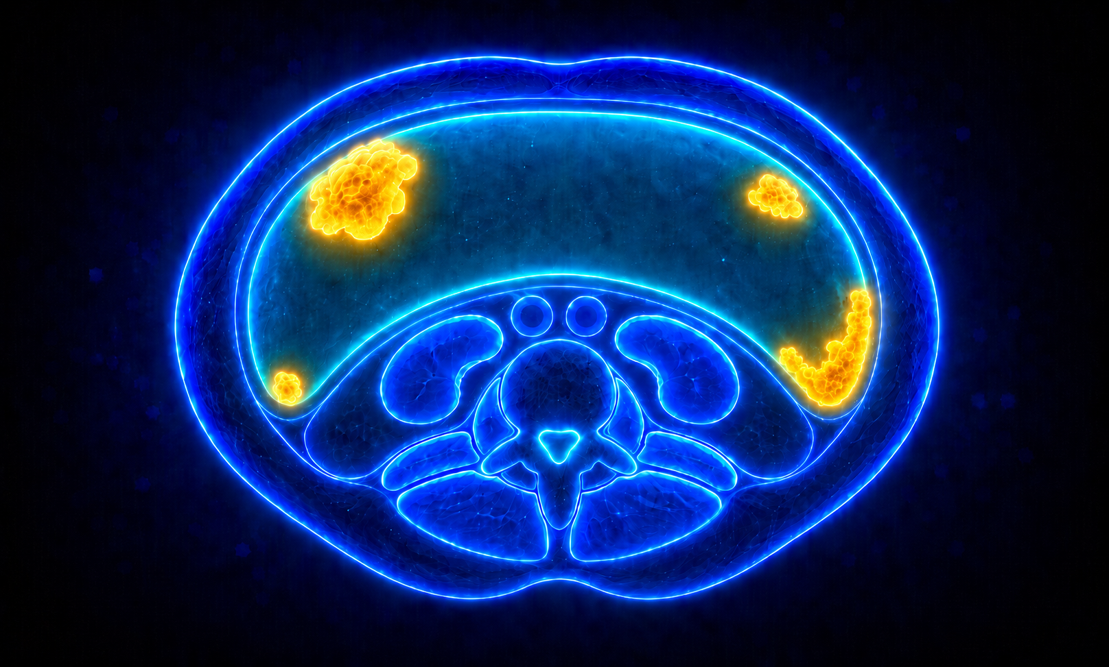 腹膜播種の模式図（腹腔内にがん細胞が点在して広がる様子）