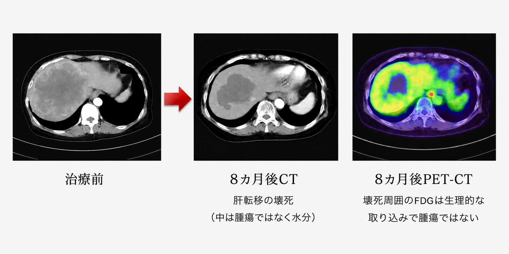 大腸がんステージ4 巨大肝転移 CT経過画像｜治療前後の比較