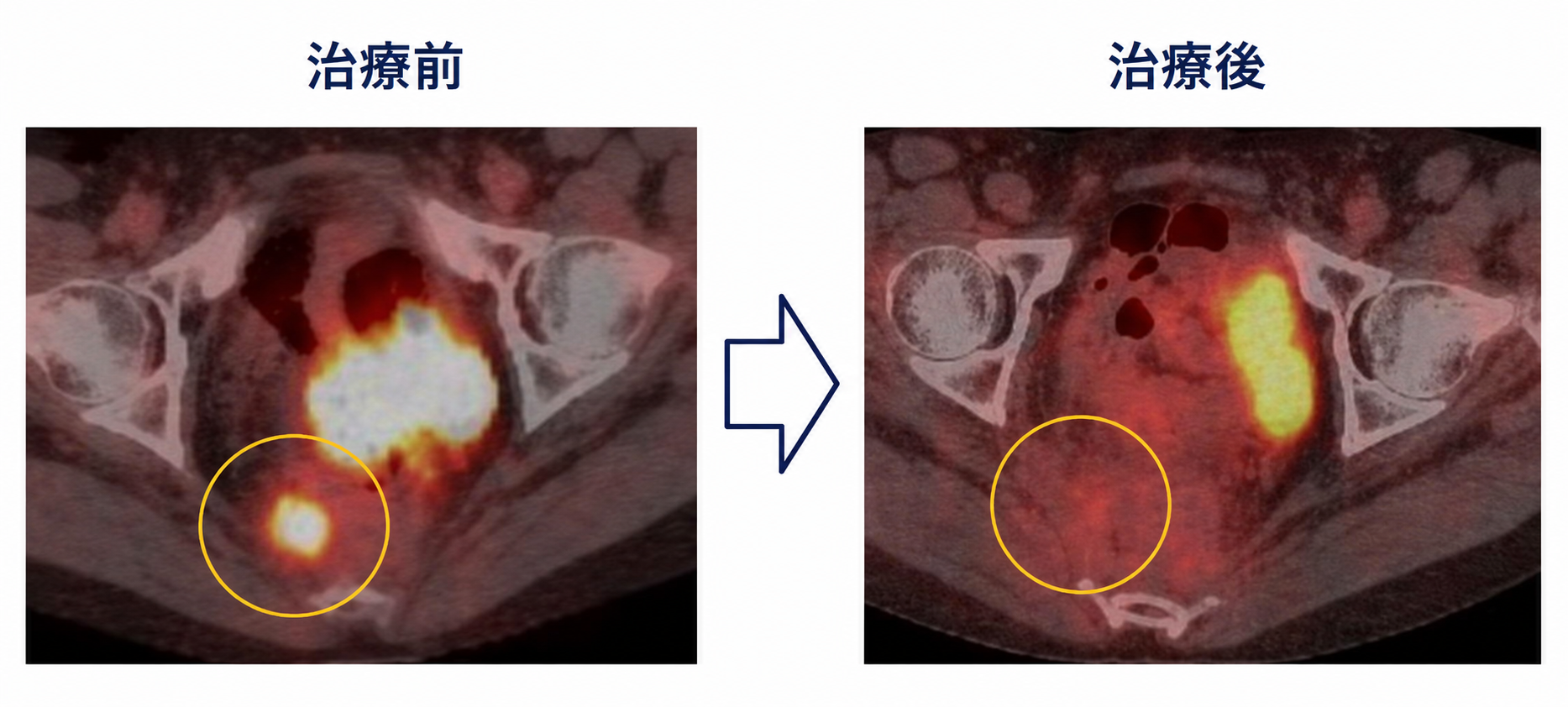直腸がんステージ4（局所再発・肺転移）治療経過の画像所見