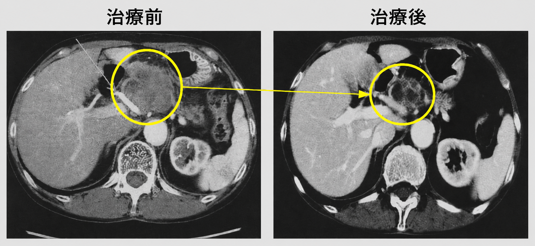 膵臓がんの経過画像