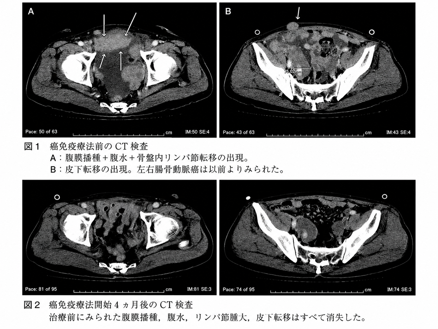 膀胱がん3356 治療経過タイムライン（抗がん剤無効後に免疫療法で全転移消失・マーカー正常化）