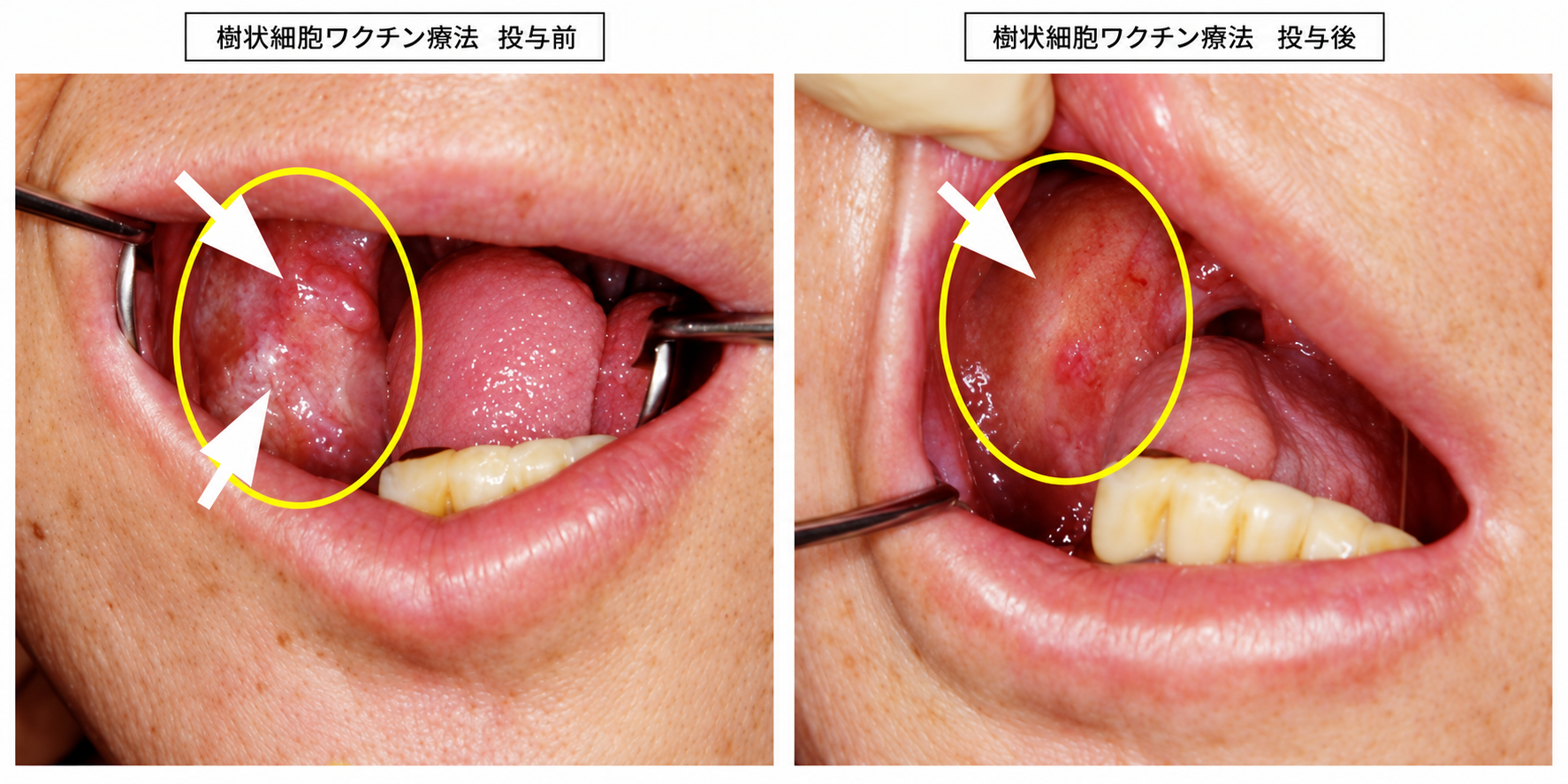 樹状細胞ワクチン投与前・投与後の舌の所見
